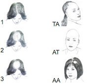 Types of female hair loss diagram