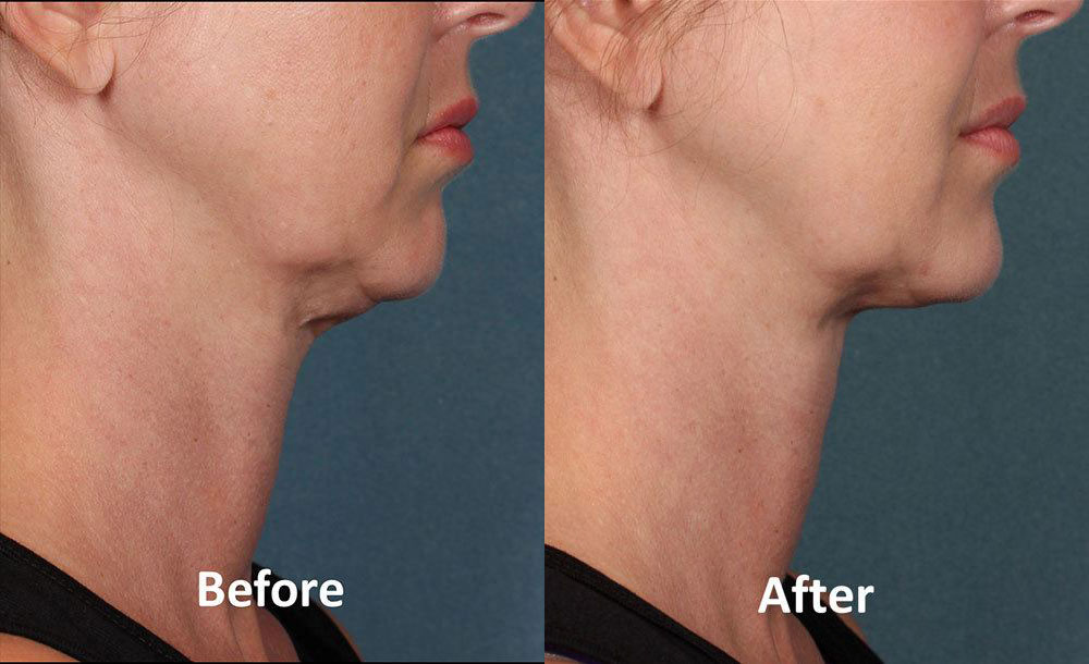 Before & After Brow Lift Surgery