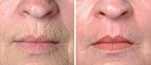 Before & After BOTOX<sup/>® Cosmetic