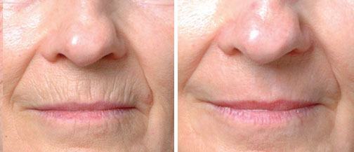Before & After BOTOX<sup/>® Cosmetic