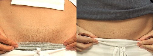 Before & After Laser Hair Removal