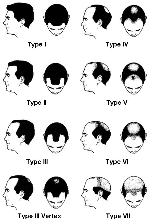 Hair Transplant Surgery For Pensacola Panama City Fl Destin