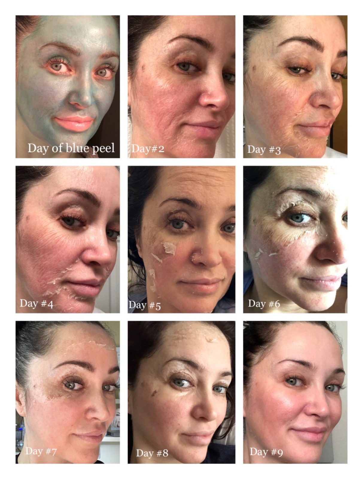 Trish's skin peeling and then improving over a 9-day recovery period