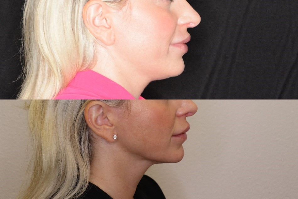Woman's face before and after renuvion