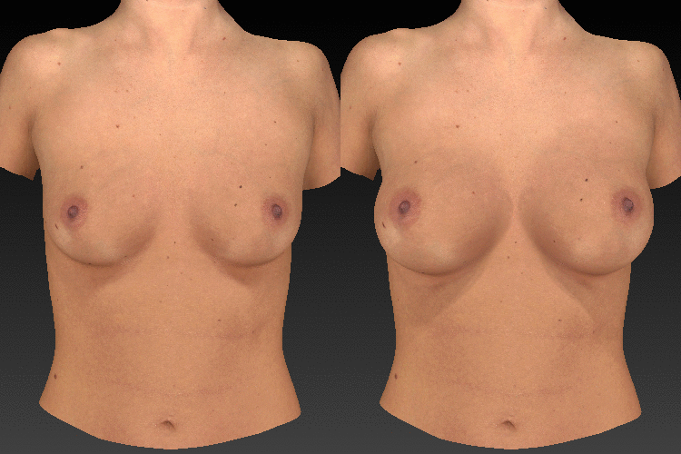 vectra breast aug animation