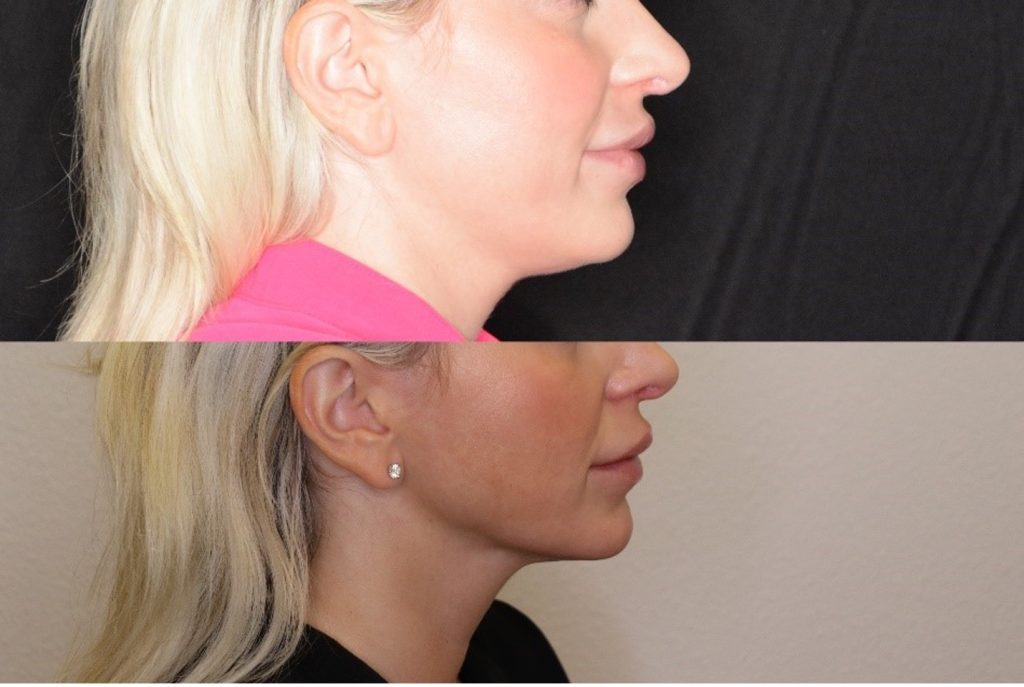 woman's side profile before and after renuvion treatment