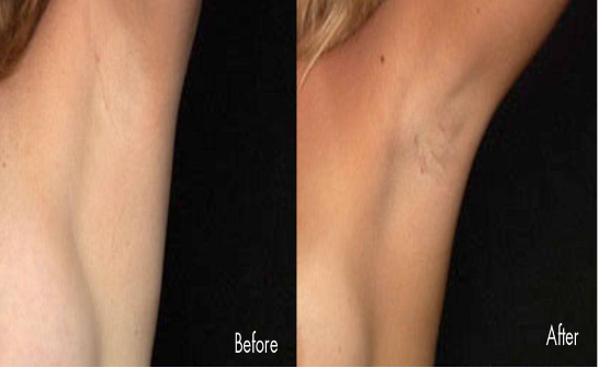 Before and After No Scar On The Breast® technique by Dr. William Burden.