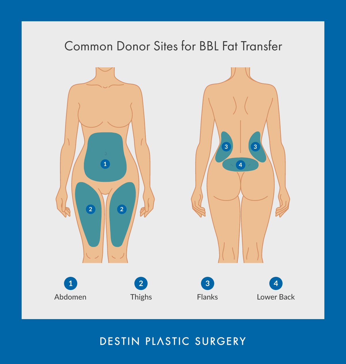 A diagram by Destin Plastic Surgery that illustrates common donor sites on a woman's back for a BBL (Brazilian Butt Lift) fat transfer.